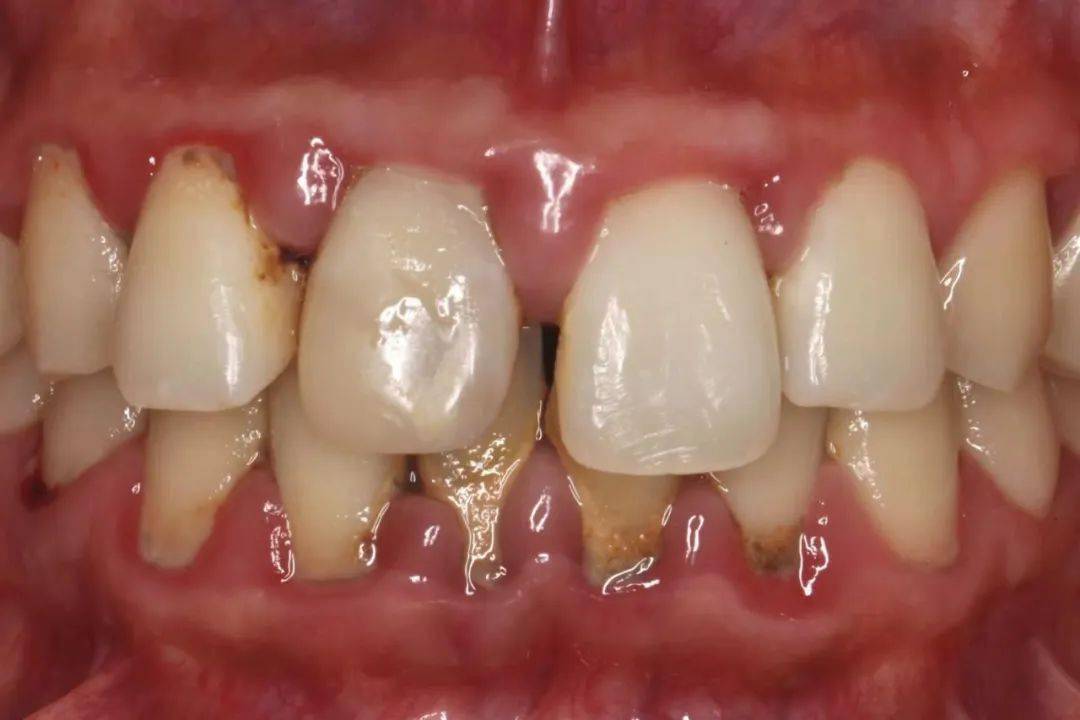 口臭|口腔患者的"难言之隐"_严重_市三院_食物残渣