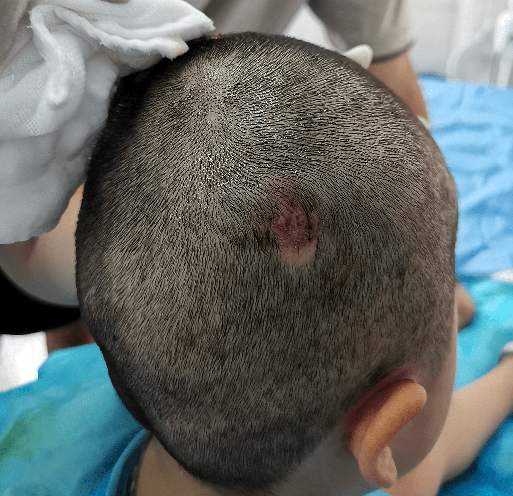 3岁女童头上长出大"蘑菇",罪魁祸首竟是家中养的它_孩子_湖南_治疗