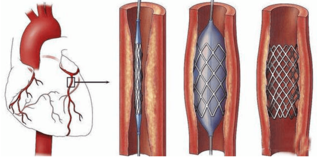 拿比较典型的冠脉支架(内科耗材)来说内资代表厂家:微创医疗,山东威高