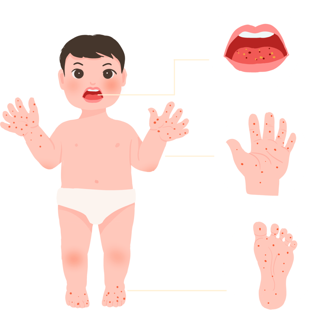 手足口病以发热,口腔黏膜疱疹或溃疡,手,足,臀等部位皮肤出疹为主要