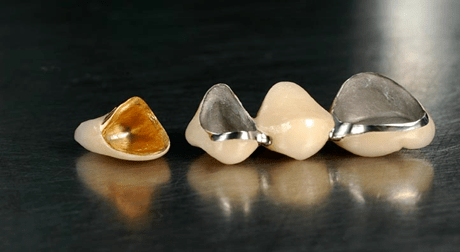 金属_牙冠_边缘