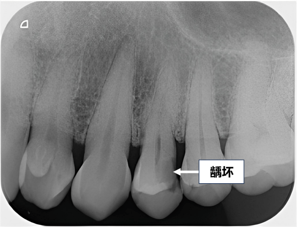 继发龋x片图片