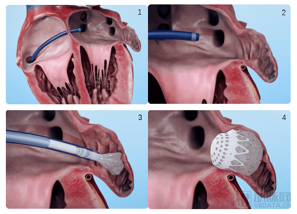 基于泡沫结构打造新型左心耳封堵器,conformal再获3500万美元融资
