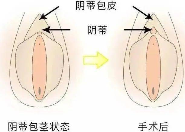 私密整形 | "小蜜豆"不敏感,无高chao怎么办?