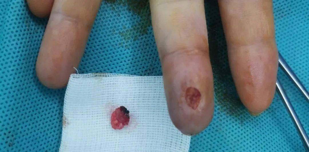 手指冒出小红点,结果长成"一碰就出血"的大包?