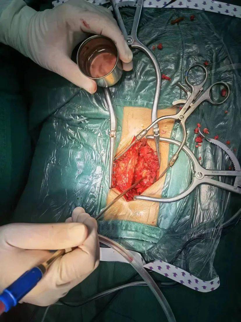 【病例分享】许昌市中心医院脊柱脊髓外科王一公,菅炎鹏团队:肌间隙