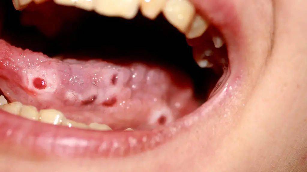 口腔溃疡是其最常见的原因之一,但也可能是疱疹病毒感染或念珠菌等