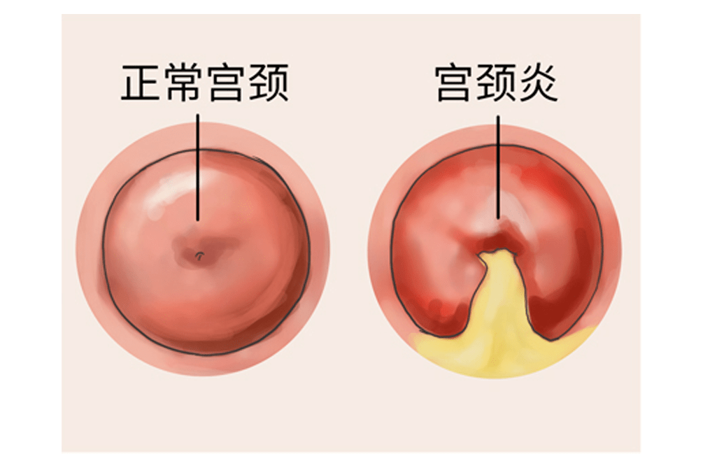 宫颈炎轻度图片图片