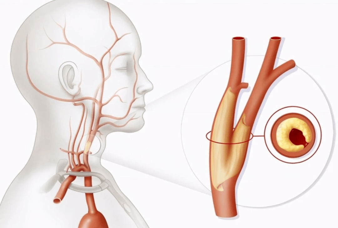 科普 带您科学认识颈动脉斑块