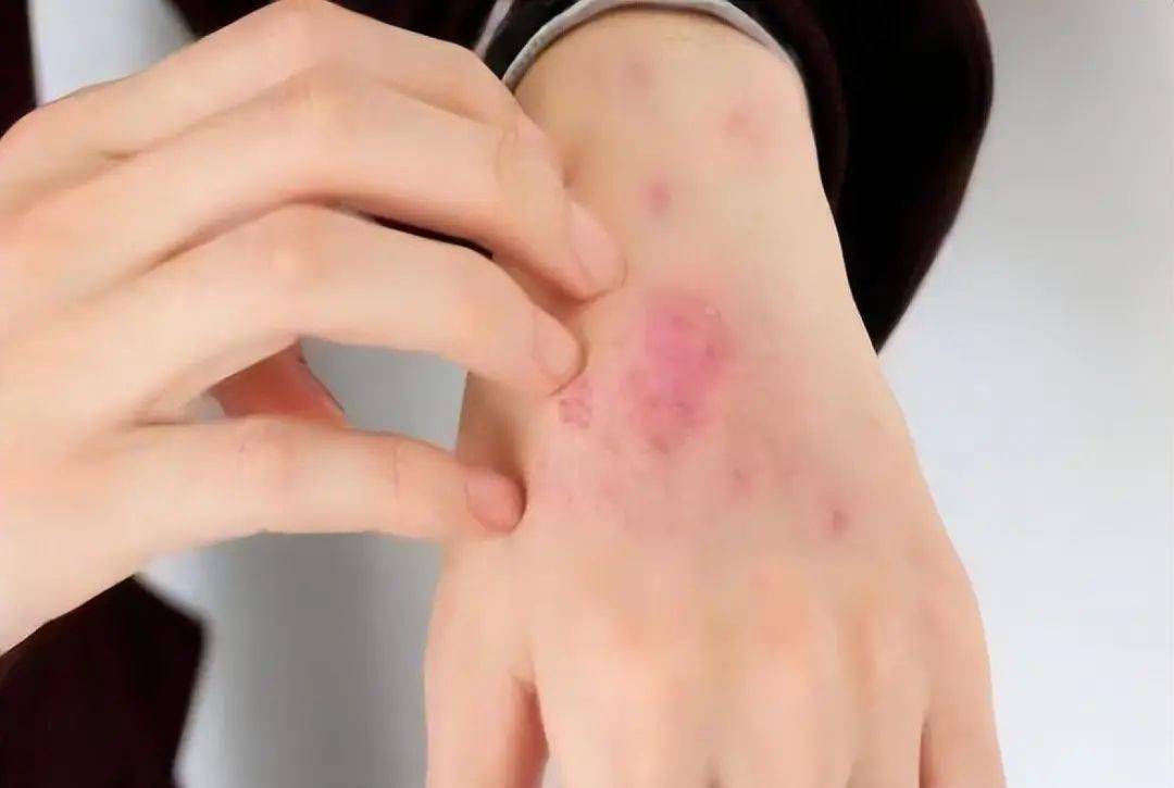 皮疹是艾滋病前期最常见的皮肤症状之一.