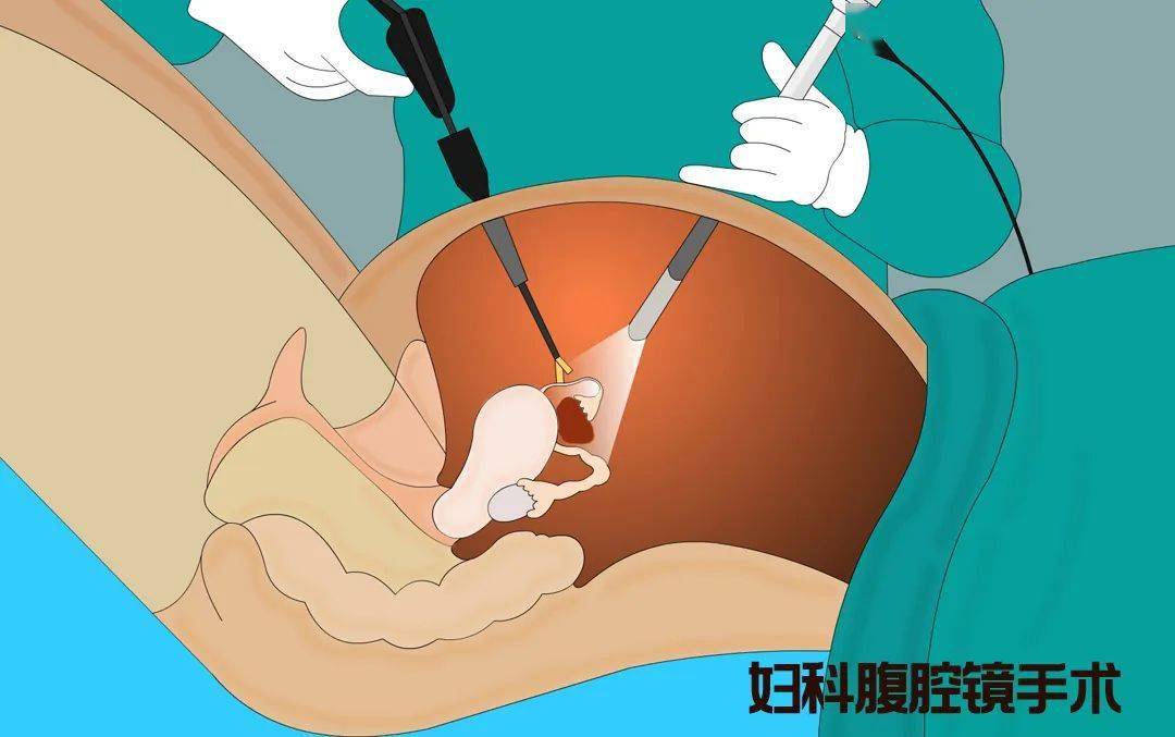 【医学科普】妇科巧克力囊肿,跟巧克力有啥关系?_治疗_患者_手术