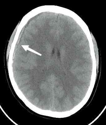 脑硬膜下血肿图片
