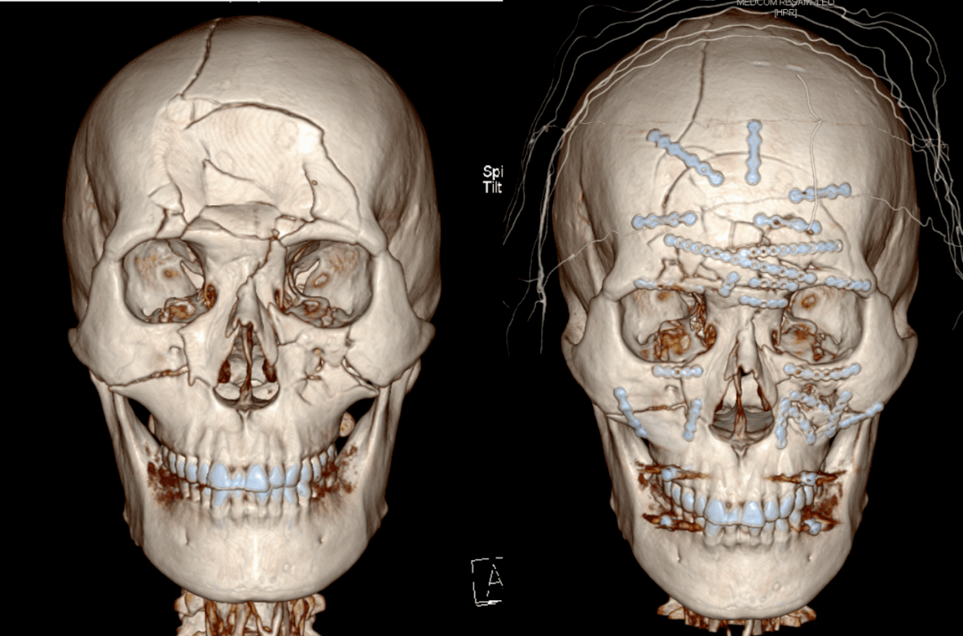 图 | 术前与术后对比在神经外科医生的通力协作下,顺利完成额窦后壁