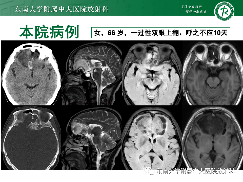 鼻顱底病變_影像_全網_解剖圖