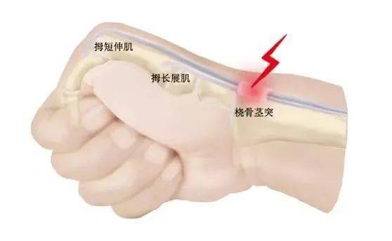 原创科普丨有一种腕关节痛叫桡骨茎突狭窄性腱鞘炎