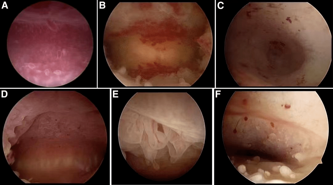 宫腔镜子宫内膜炎图片