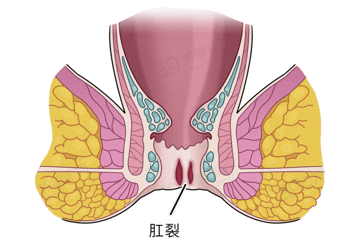 【上海中佑肛肠医院】肛裂为什么这么痛?