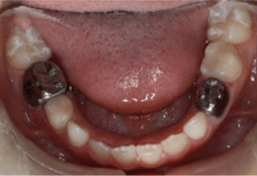 儿童乳磨牙的保护伞是什么?