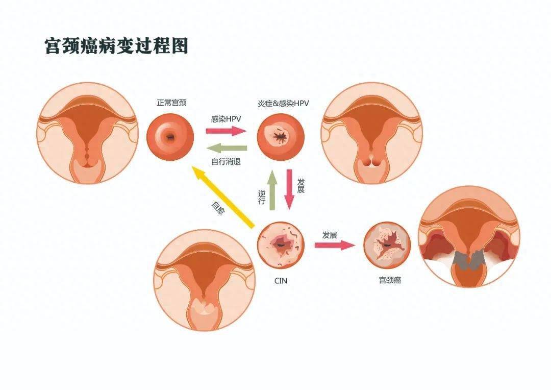 hpv传染性强吗 来自搜狐网