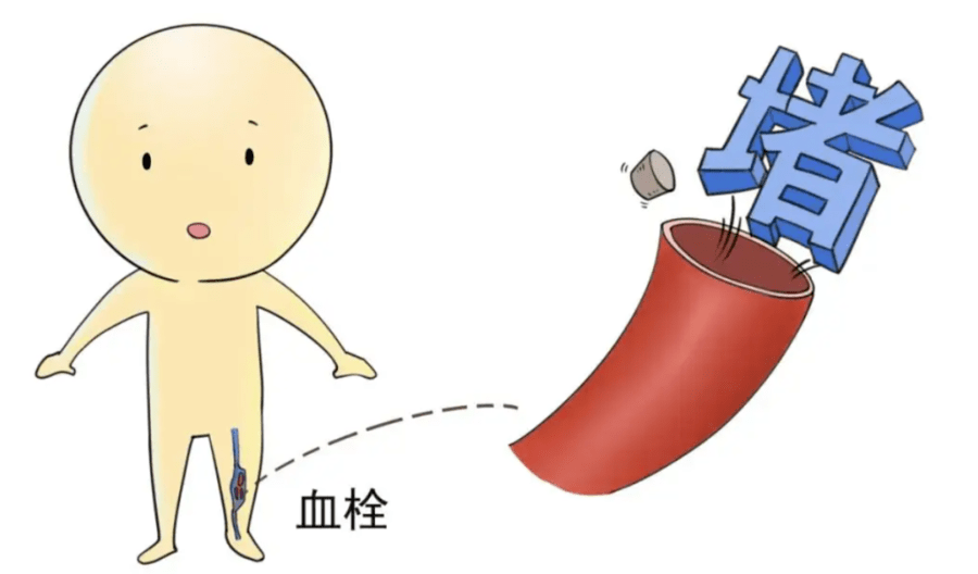 关于儿童静脉血栓,你了解多少?_血管_下肢_血液