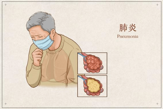 吸入性肺炎是指吸入异物或口咽分泌物移位进入下呼吸道而导致的肺部
