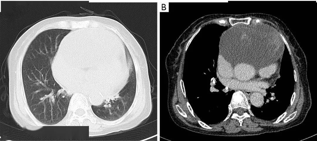 一例通过纵隔肿瘤切除诊断和治疗的心包间皮瘤病例|imdt 专栏_患者