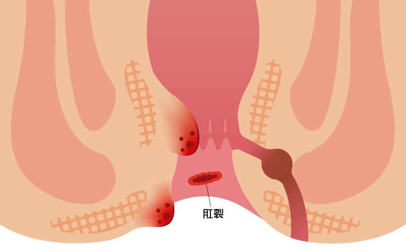哨兵痔和普通痔疮有什么区别?原来都是肛裂惹的祸_肛肠医院_治疗_患者