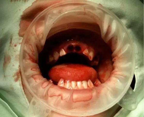 牙医不得不给人们看看这些恐怖的照片……_小孩_牙齿_糖分