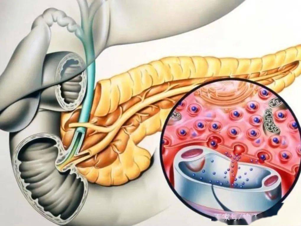 急性胰腺炎 