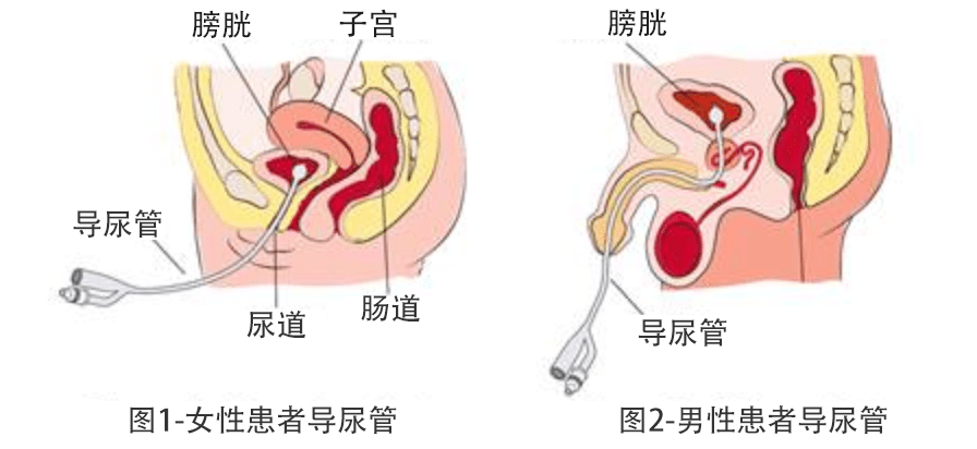 导尿术女性尿道口位置图片