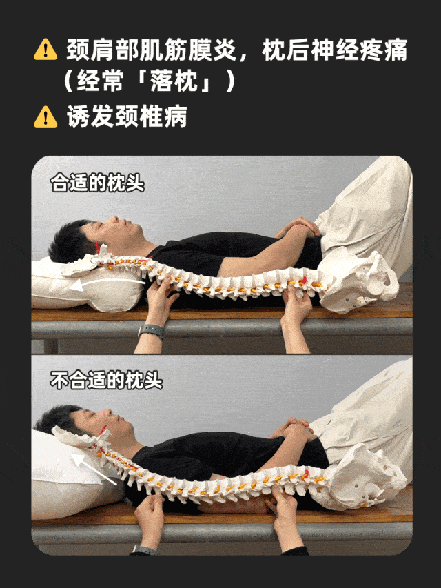 睡高枕头会驼背吗?
