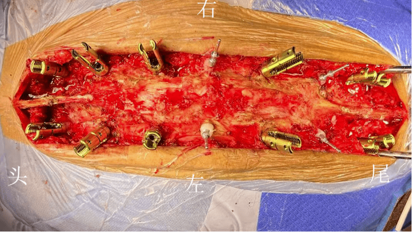 宣武有术|双节段cowo截骨治疗强直性脊柱炎重度后凸畸形_手术_疑难