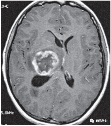 右側基底節區明顯不均質環形強化腫塊,環不規則,內緣毛糙,側腦室前角