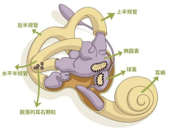 耳石症,学名为良性阵发性位置性眩晕,是指头部相对于重力方向迅速运动