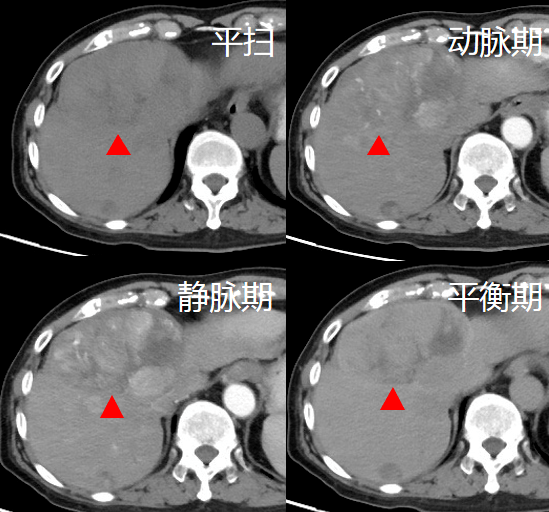 科普| 增强ct—去掉病灶的"隐身衣"_检查_病变_进行