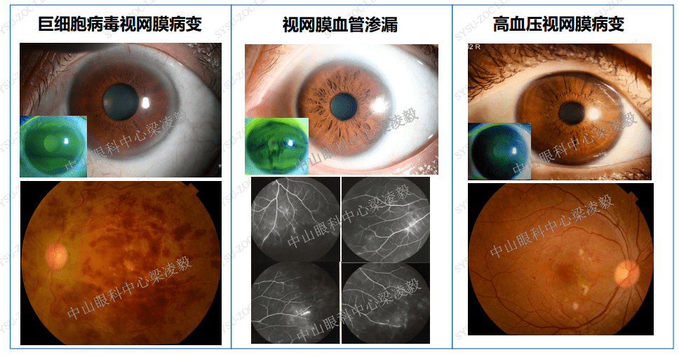 梁凌毅教授:造血干细胞移植术后眼部并发症及其影像学表现