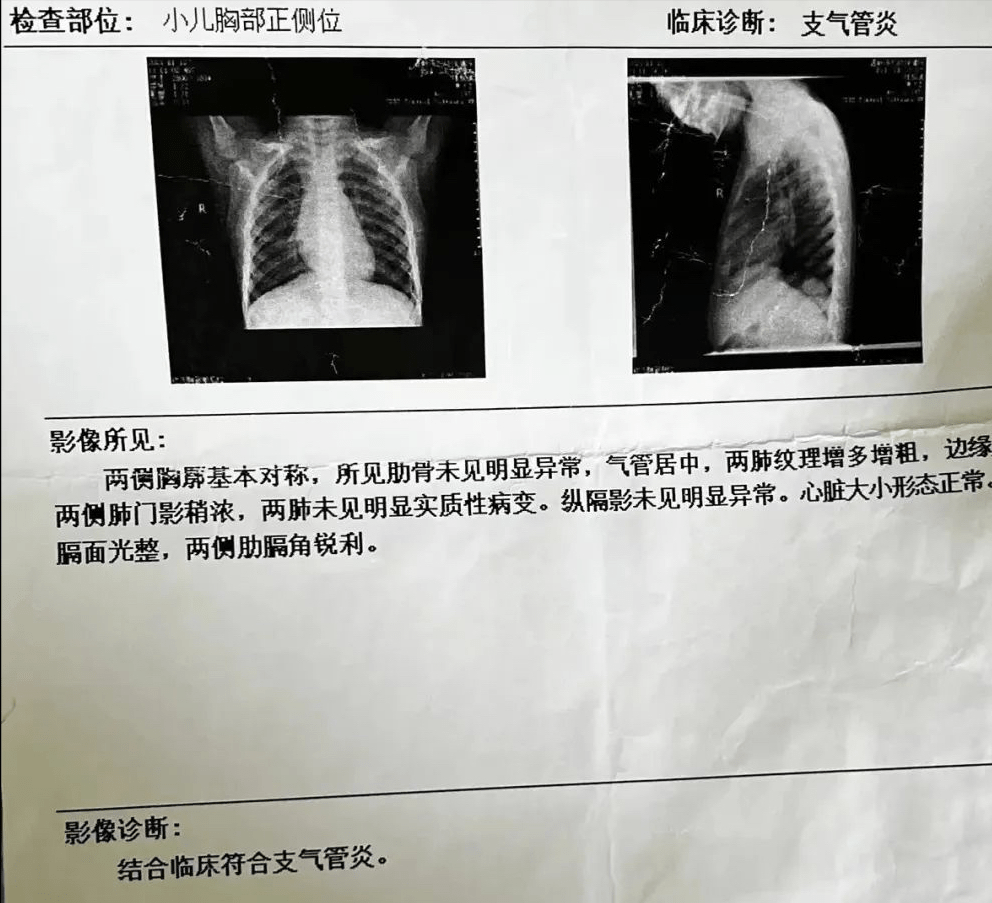 肺纹理增多增粗