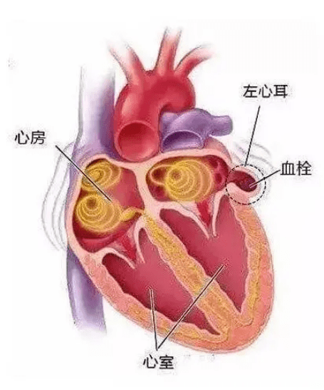 左心耳血栓图片