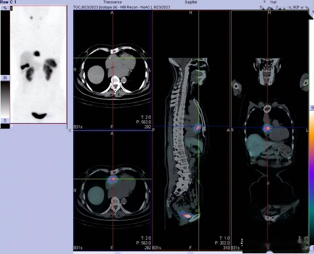肿瘤血儿茶酚胺水平检测结果阳性奥曲肽显像肾上腺未见异常答案明确了