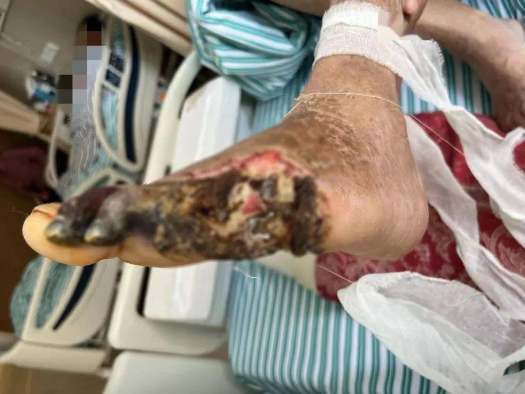 从脚部一个小伤口竟发展到要截肢?他究竟经历了什么_王大爷_血管_治疗