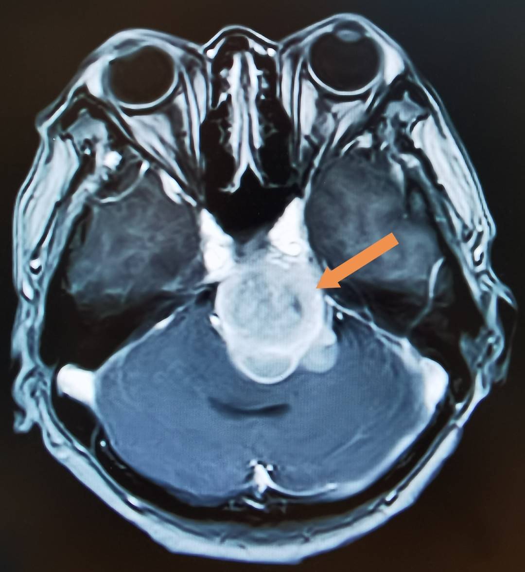 四川蓝生脑科医院成功切除巨大蝶岩斜坡型脑膜瘤_手术_病人_肿瘤