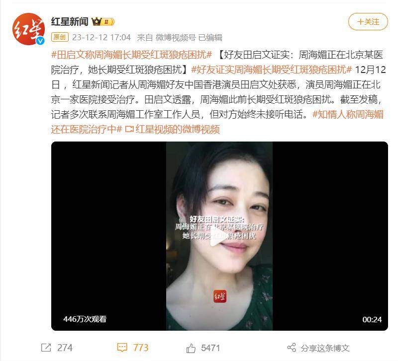 演员周海媚长期受红斑狼疮困扰,这种"不死的癌症"尤其偏爱女性_患者