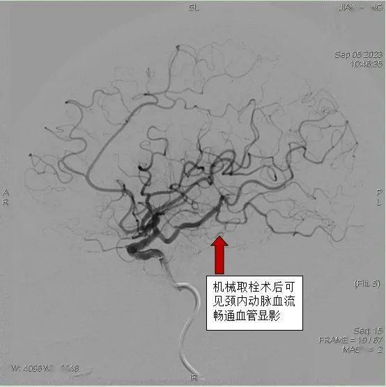 急診頭顱cta三維重建示左側考慮,左側大腦中動脈m1段局部管腔變窄