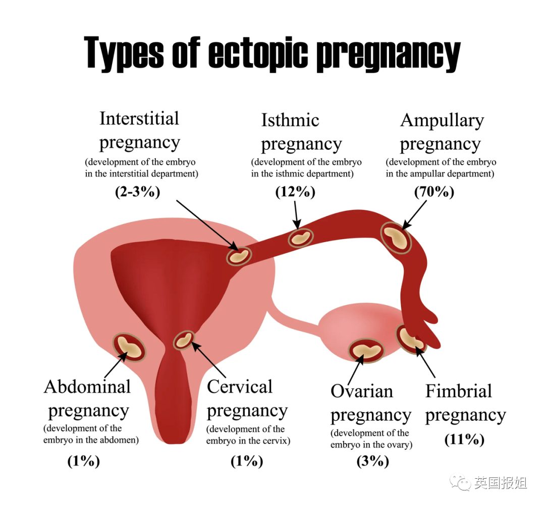 女子腹痛竟發現腸道內有6月大胎兒?