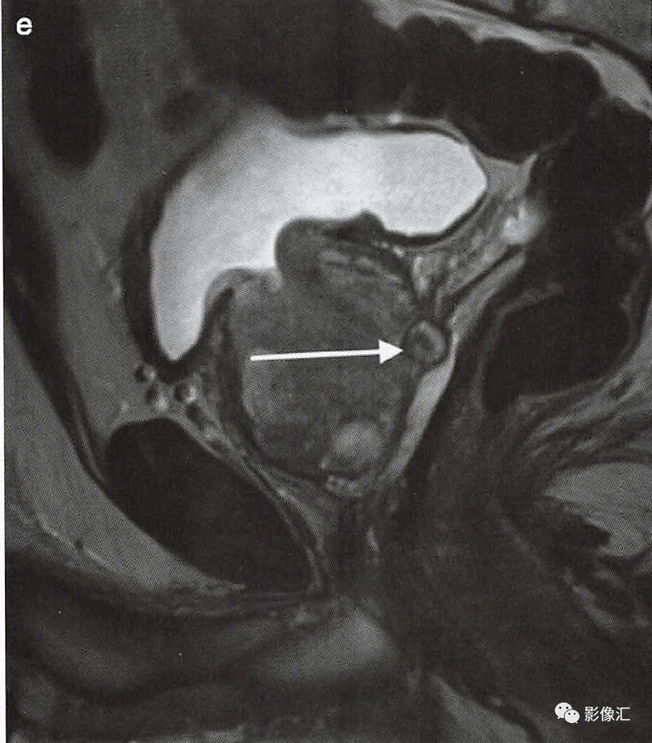 前列腺磁共振正常图像图片