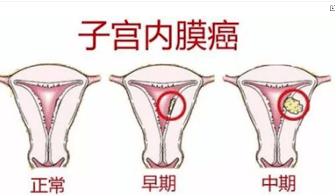 有可能是子宮內膜癌!提高警惕和及時就診檢查很重要~_患者_治療_診斷