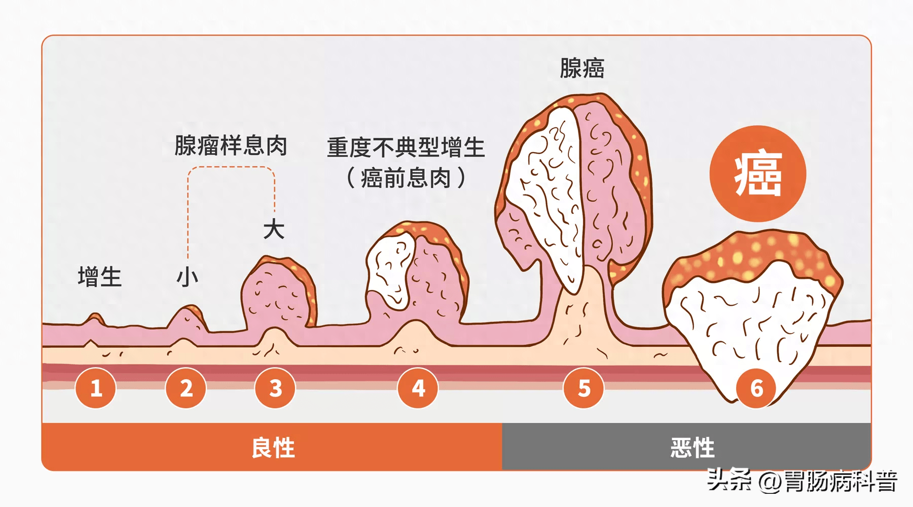 从息肉到肠癌——一枚息肉的逆袭史