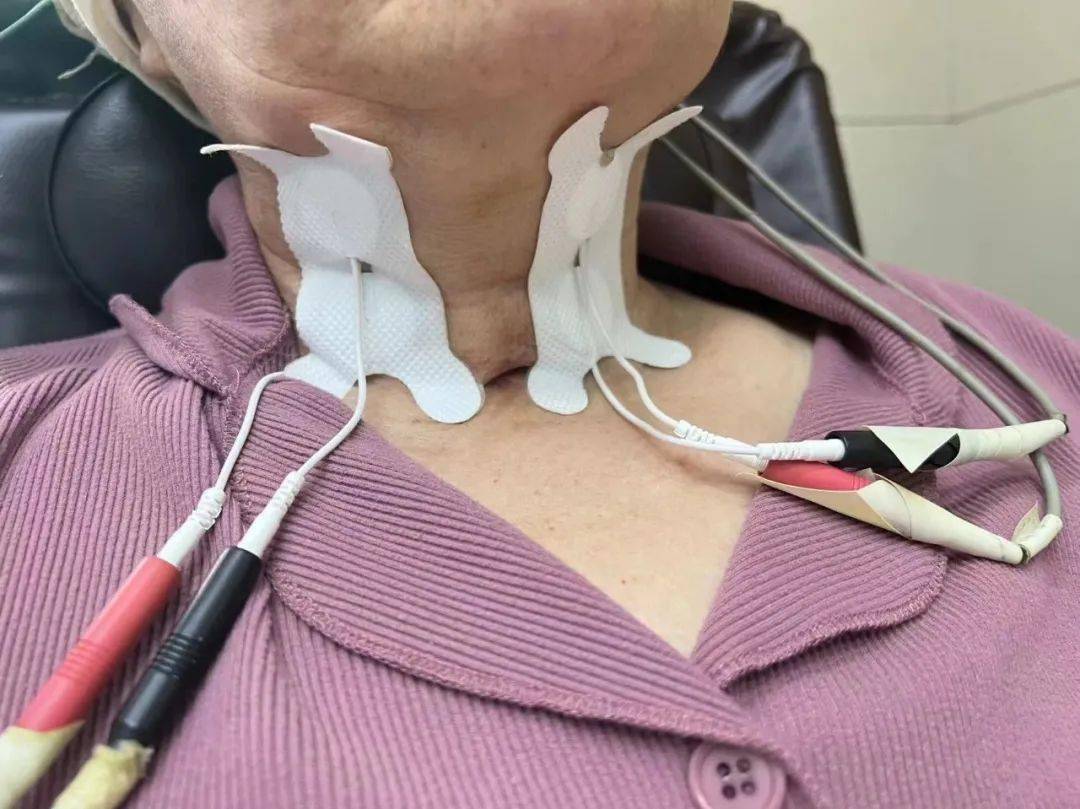 球囊扩张术球囊扩张术主要针对存在环咽肌失弛缓症或吞咽动作不协调