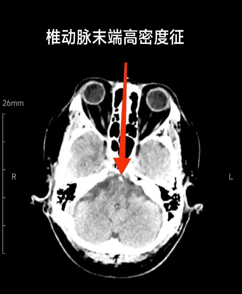 術前顱腦ct提示:左側椎動脈v4段高密度徵.