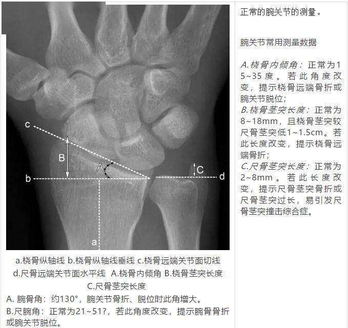 腕关节尺偏位图片